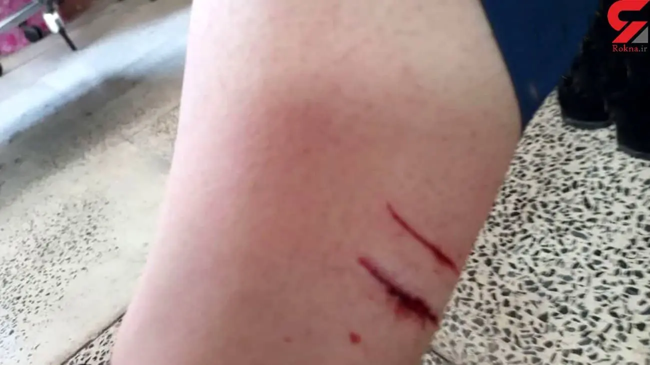 حمله سگ به دانش آموزی پرندی زخم عمیقی برداشته است.