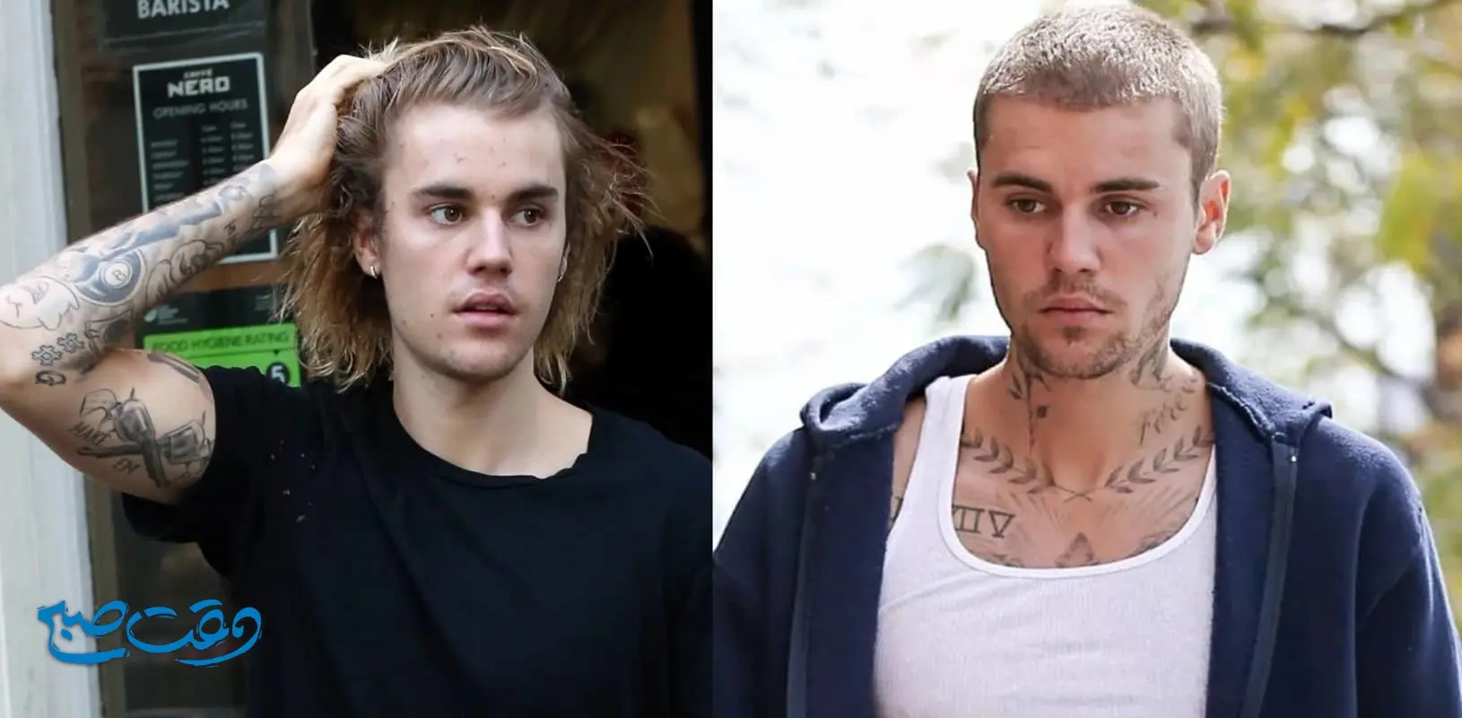 Justin-Bieber-Hair-Transplant (1)