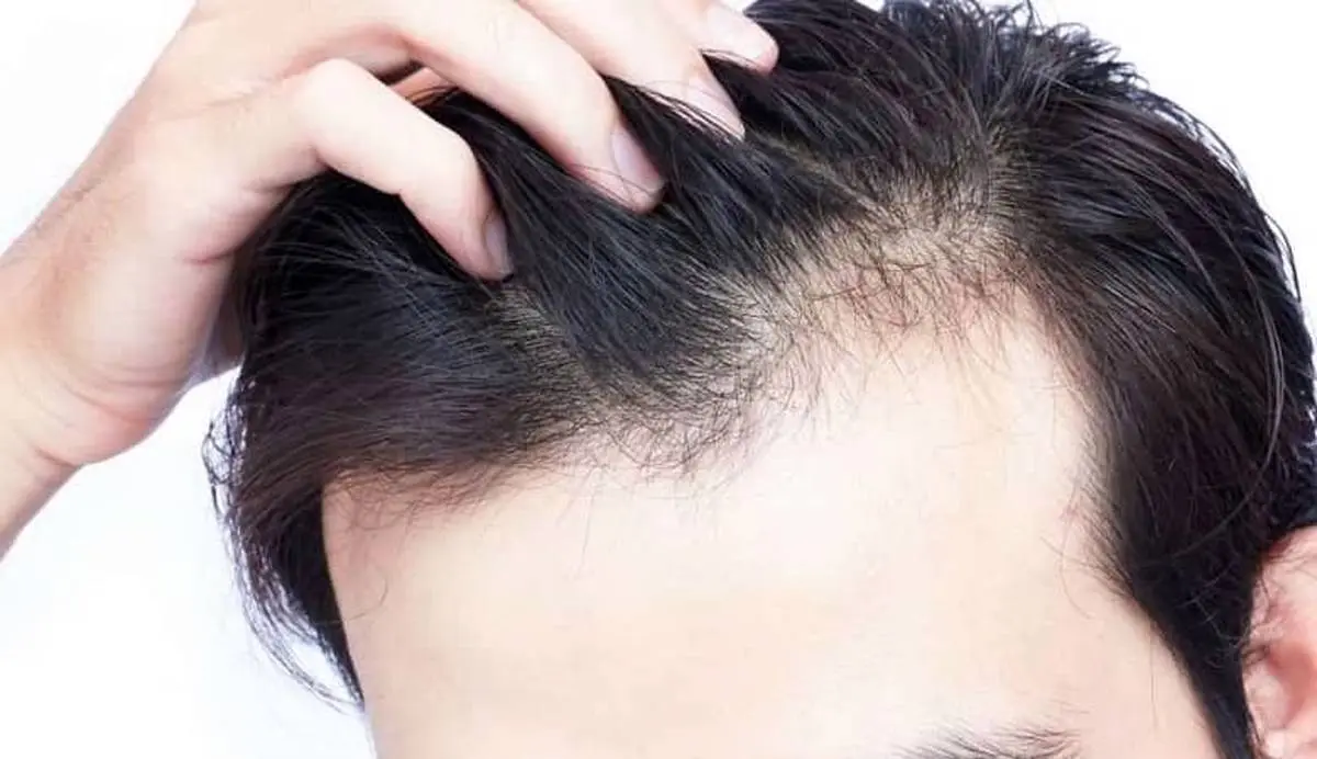 علت اصلی ریزش مو را بشناسید!